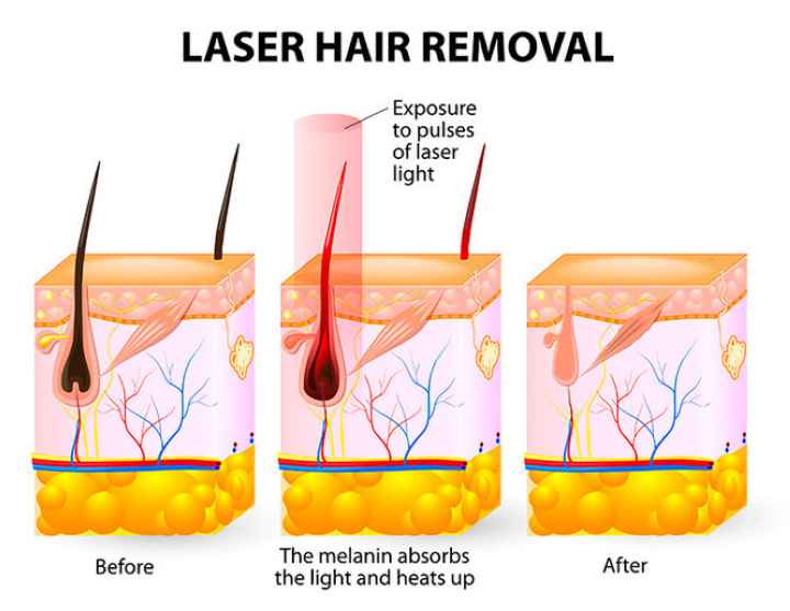 Лазерное удаление волос